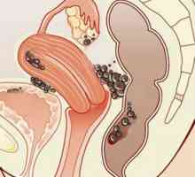 Endometrióza a těhotenství