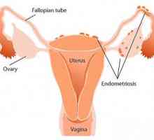 Endometrióza děložní příznaky a léčba