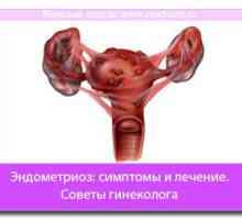Endometrióza: příznaky a léčba. Tipy gynekolog