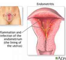 Endometritida - jaký druh infekce a jak ji léčit?