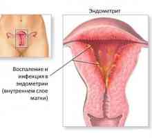 Endometritida a endometriózy - v melodii s názvem, ale různé diagnózy