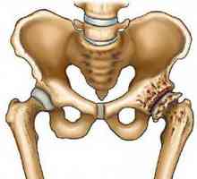 Endoprotéza - Hip Nahrazení