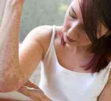 Léčba erythrasma a symptomy