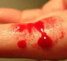 Jak zastavit kapilární krvácení