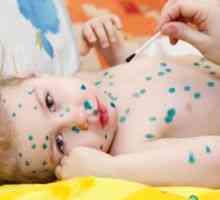 Jak rychle vyléčit plané neštovice u dítěte doma?
