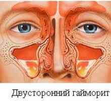 Jak a čím správně léčit zánět vedlejších nosních dutin?