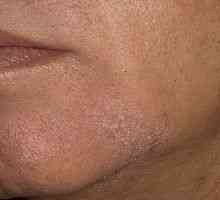 Jak se zbavit seborrhoické dermatitidy na obličeji? Určíme příčinu onemocnění.