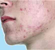 Jak se k léčbě akné vulgaris