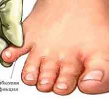 Jak léčit plíseň nohou? Příznaky doprovázející tuto nemoc.