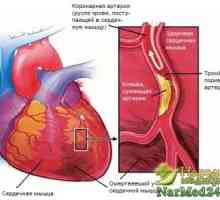 Jak k léčbě anginy srdce za použití tradičních metod