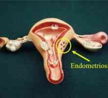 Jak identifikovat endometriózy a děložních ji vyléčit? Zvážit všechny možnosti