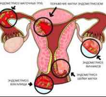 Jak se přípravek Janine endometriózy