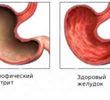 Jak je subatrophic gastritida?