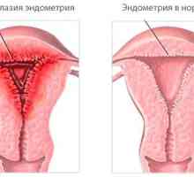 Jak provádět léčbu hyperplazie endometria lidových prostředků?