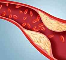 Jak snížit hladinu cholesterolu v krvi