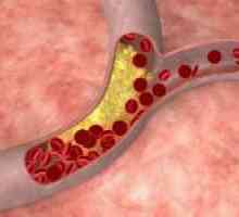 Jak léčit aterosklerózu a je to možné?