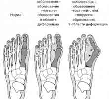 Jak vyléčit kost na noze: hladká a zdravá noha