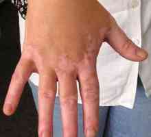 Jak léčit vitiligo, za použití konzervativních způsobů léčby