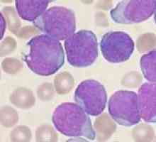Příznaky rakoviny krve u dospělých a dětí