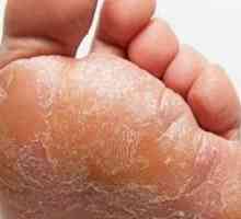 Jaké jsou mast houby na nohou? Tipy pro domácí léčbu.