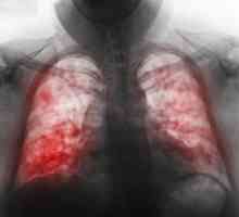 Jaké jsou příznaky zápalu plic u dětí? Diagnostika onemocnění.