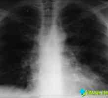 Jaké jsou příznaky zápalu plic: hlavní rysy tohoto onemocnění