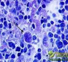 Jaké jsou příznaky toxoplasmózy, léčba chorob lidových prostředků