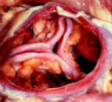 Kalcifikace aortální chlopně