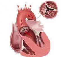 Kalcifikace srdce a cév: vzhled, funkce, diagnostika, léčba