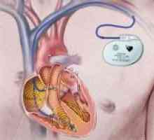 Kardiostimulátor pro srdce