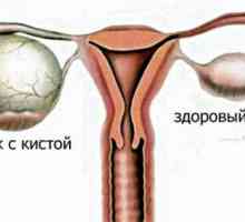 Ovariální cysty v průběhu těhotenství
