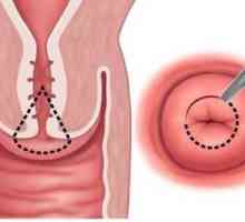 Klasifikace a léčba cyst na děložním čípku
