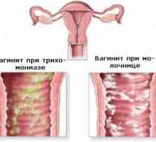 Coleitis (vaginitida), u mužů i žen