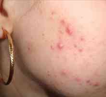 Kožní roztoči na obličeji: léčba a prevence