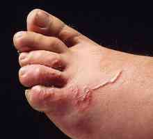 Skin larvální toxokaróza - příznak nemoci a léčby
