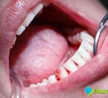 Krvácení z dásní při čištění zubů: jaké jsou důvody