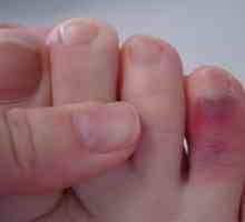 Léčebné taktiky zranění prstu