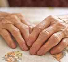 Léčbě artritidy rukou kloubů