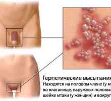 Genitální herpes Léčba různých lidových prostředků