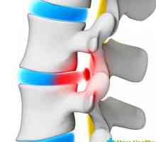 Léčení spinální herniace