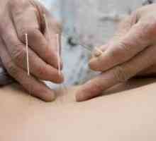 Léčba akupunkturou
