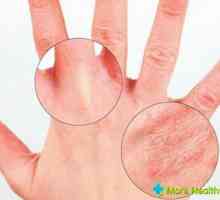 Léčba seboroické dermatitidy: Příčiny