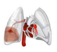 Krvácení do plic: příčiny, příznaky, tvary, léčba
