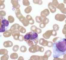 Leukemoid krevní reakce