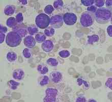 Leukocyty v moči - co to znamená? Příčiny bílých krvinek v moči.