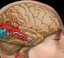 Malformace mozkových cév