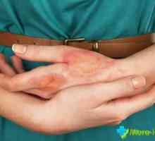 Masti z dermatitidy na rukou: cenově nejdostupnější a efektivní