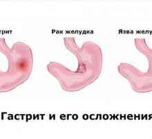Způsoby léčby hypertrofické gastritidy