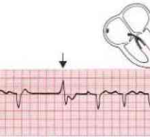 Způsoby léčení srdečních arytmií
