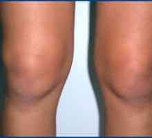 Metody léčby synovitidy kolena. Příznaky tohoto onemocnění.